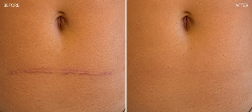 Visible improvement in scar texture with consistent use