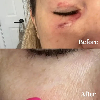 Amuee Silicone Scar Tape