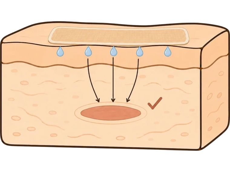 Silicone Occlusion